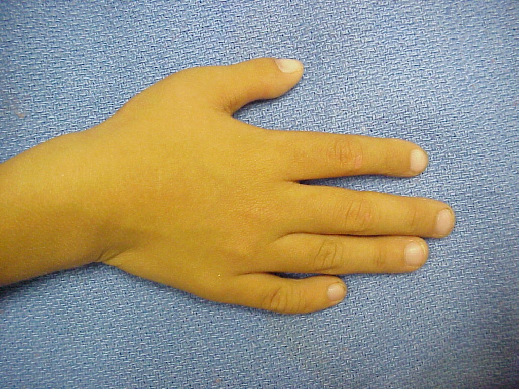 На 1 руке 6 пальцев. Преаксиальная полидактилия. Постаксиальная полидактилия кистей.
