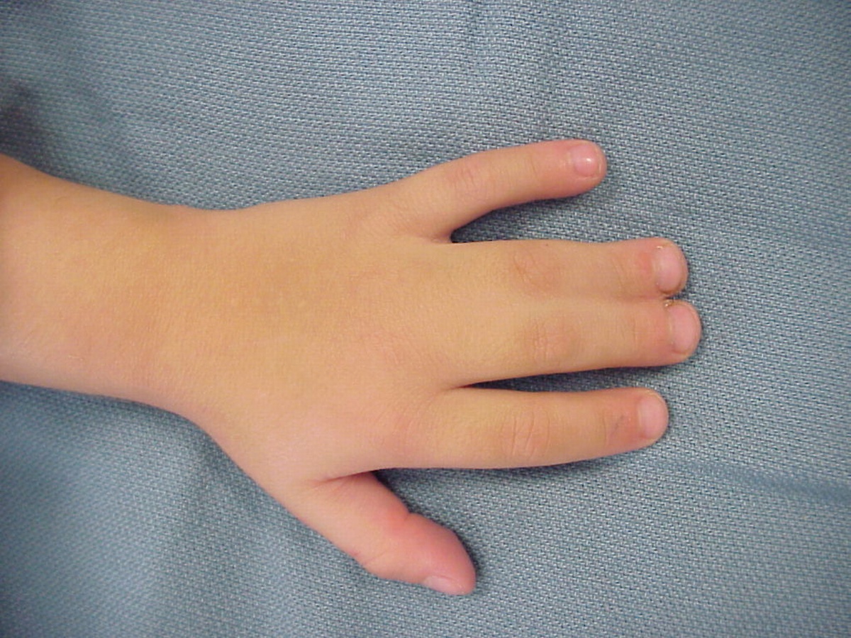 Рука нога когда у ребенка. Пороки развития кисти синдактилия. Синдактилию патология. Перепончатая синдактилия.
