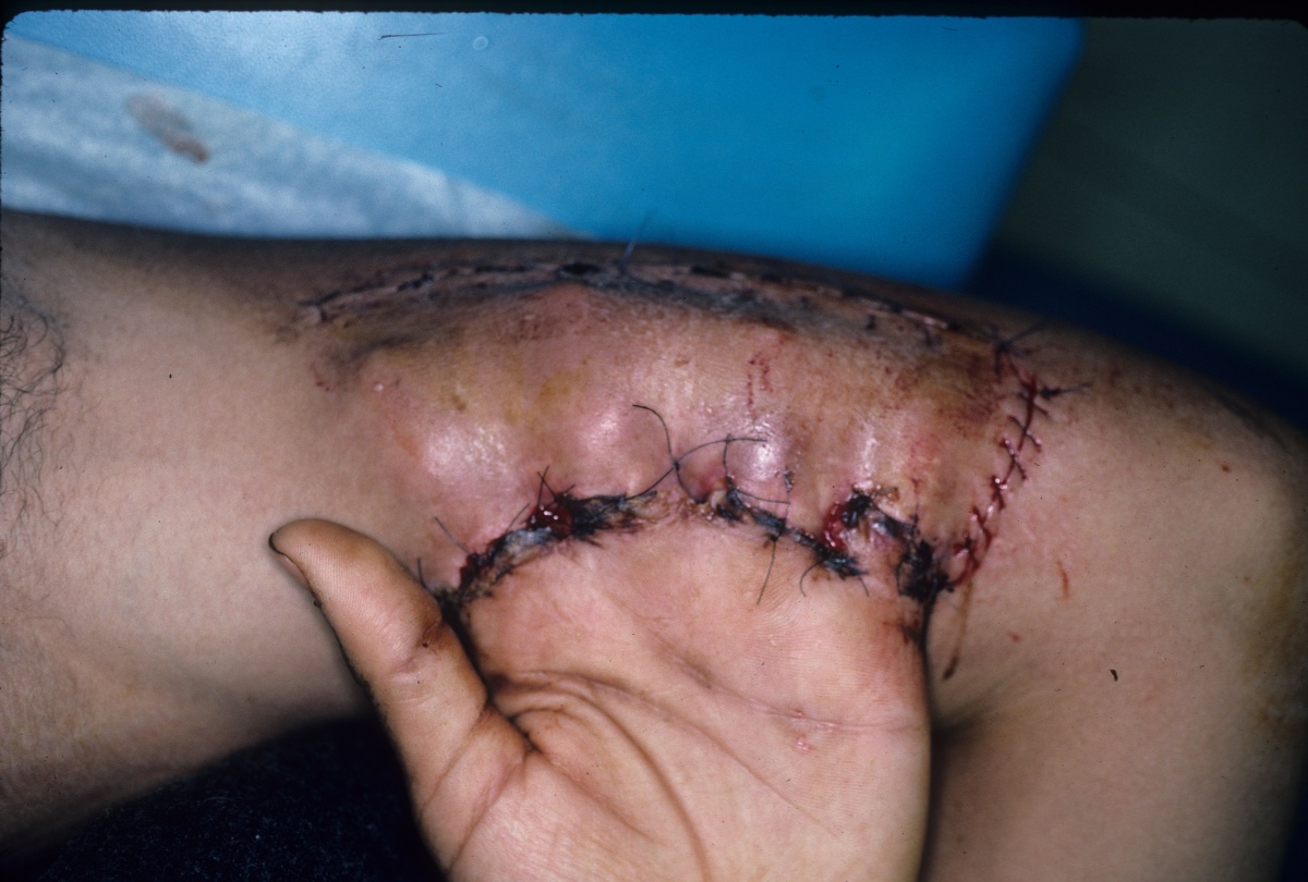 Clinical Example: Multiple finger degloving treated with medial cross arm f...