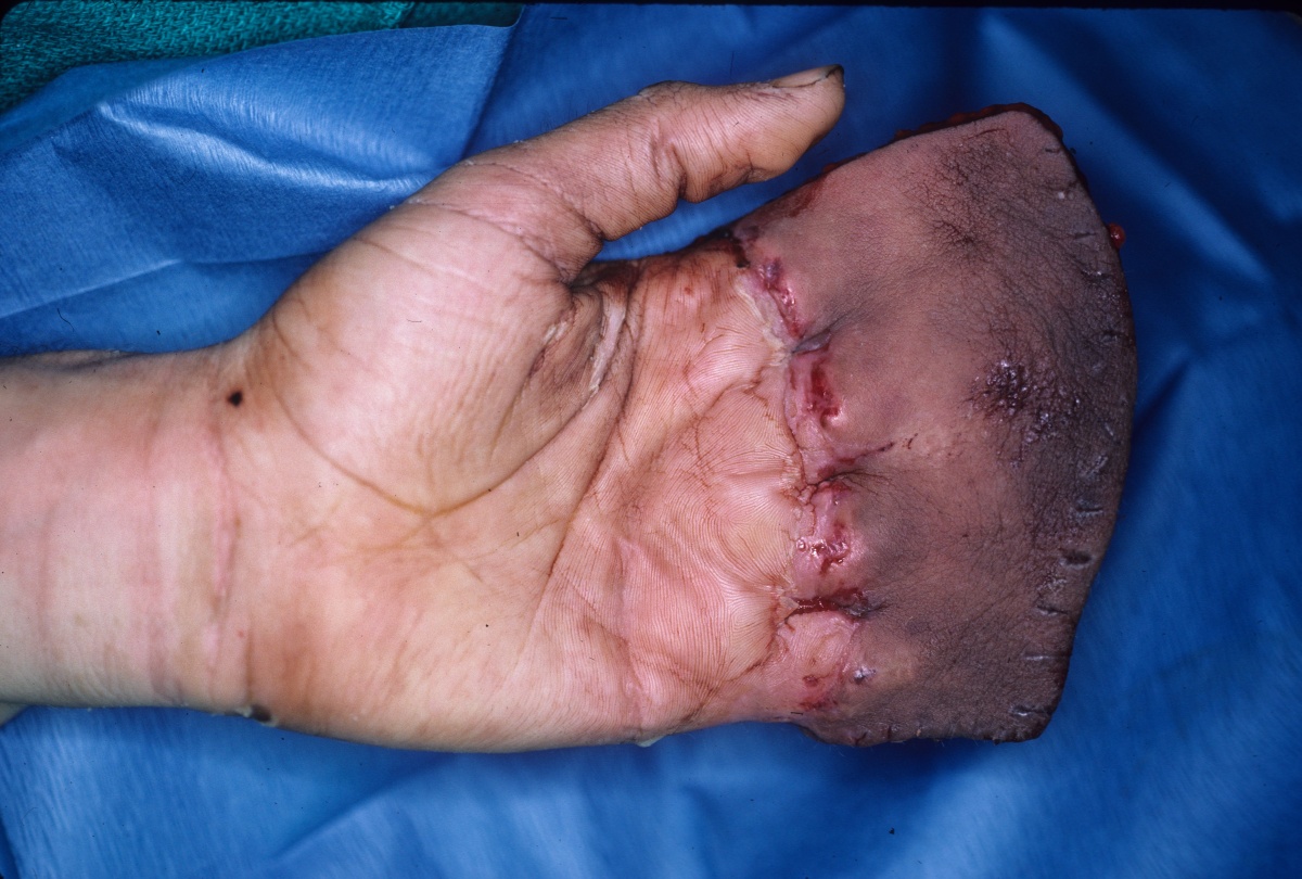 Clinical Example: Multiple finger degloving treated with medial cross arm f...
